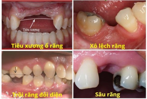 Hậu quả của việc không điều trị khi mất răng