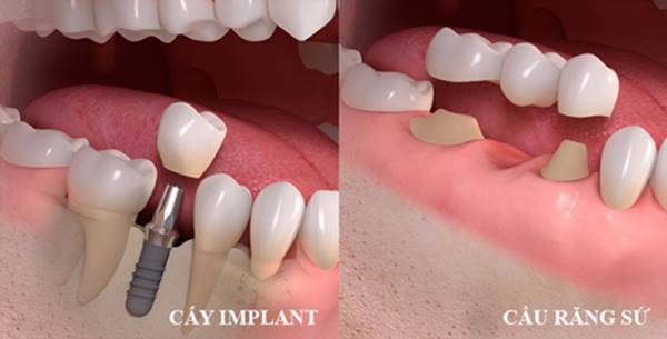 Dùng phương pháp cấy implant và cầu răng sứ cho răng bị gãy nhiều