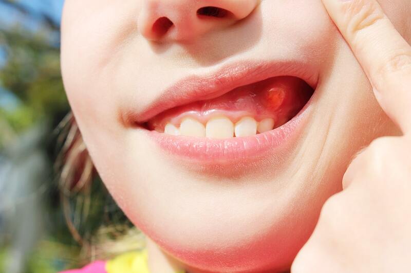 Răng mọc ngầm nên nhổ hay chỉnh nha kéo răng?