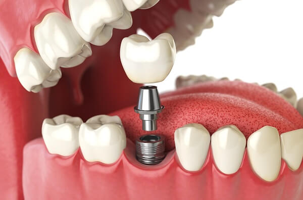 Nghiễn răng có thể gây ra nhiều tổn thương cho răng implant