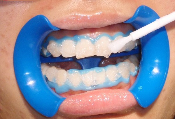 Tình trạng ê buốt thường sẽ không kéo dài quá lâu sau khi tẩy trắng răng