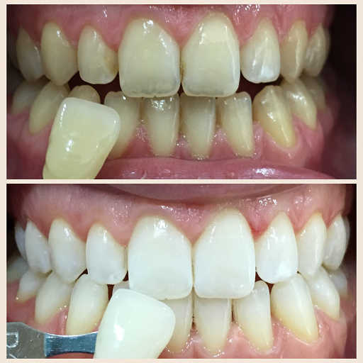 Hàm răng trắng giúp bạn tự tin hơn
