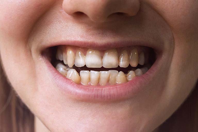 Nền răng kém sẽ làm răng nhạy cảm hơn sau khi tẩy