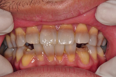 Có rất nhiều nguyên nhân dẫn đến răng bị nhiễm màu