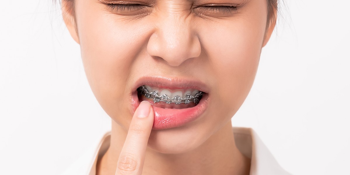 Lý giải nguyên nhân niềng răng làm răng bị rụng sớm