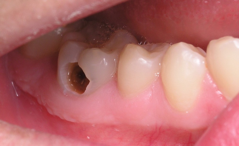 Một trong những dấu hiệu nhận biết răng chết tủy