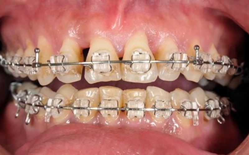 Viêm nha chu là một trong những nguyên nhân gây rụng răng khi đang niềng