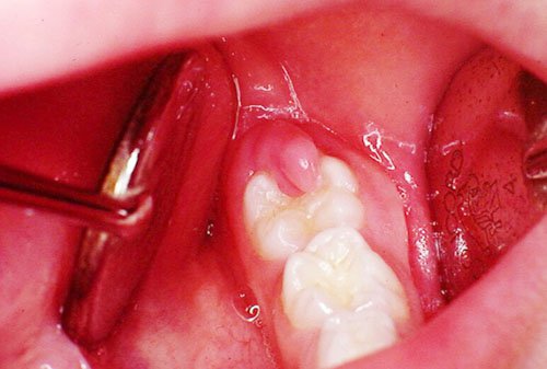 Nướu răng đỏ khi bị viêm sưng