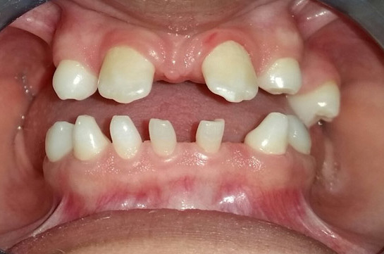 Đã có nhiều cách để khắc phục tình trạng thiếu răng bẩm sinh