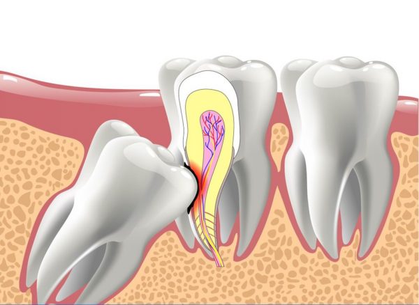 Răng khôn thường ảnh hưởng đến cuộc sống bạn