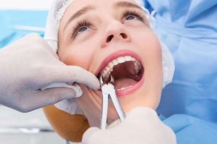 Nhổ răng có gây hại không?