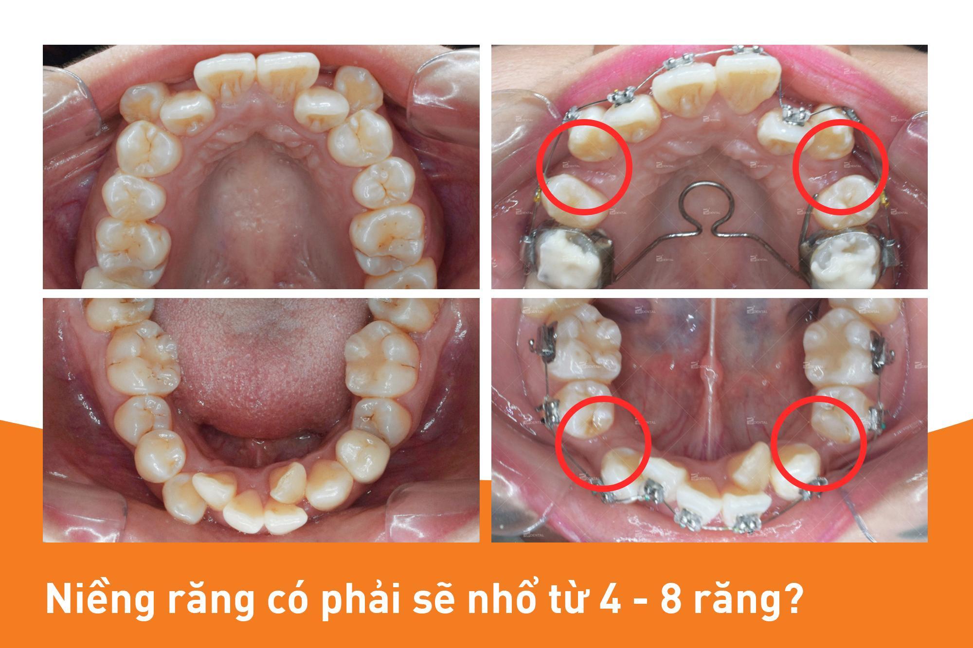 Các vị trí răng thường sẽ nhổ khi niềng răng