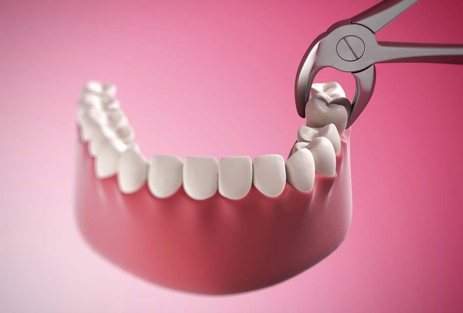 5 dấu hiệu nhổ răng khôn bị nhiễm trùng và cách xử lý
