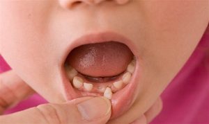 Hướng dẫn cách nhổ răng sữa không đau và an toàn tại nhà