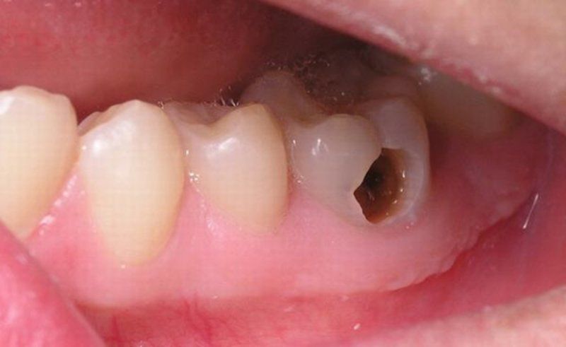 Răng bị sâu cần được điều trị sớm