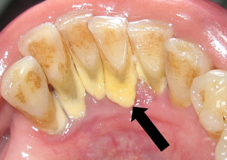 những tác hại của cao vôi răng