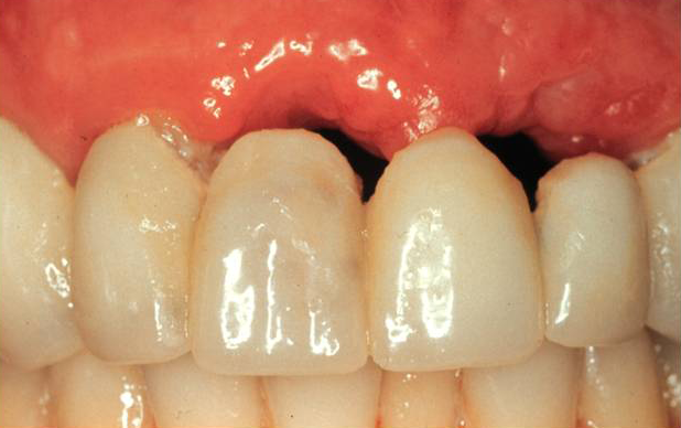 Răng hàm bị tiêu sau một thời gian dùng cầu răng sứ