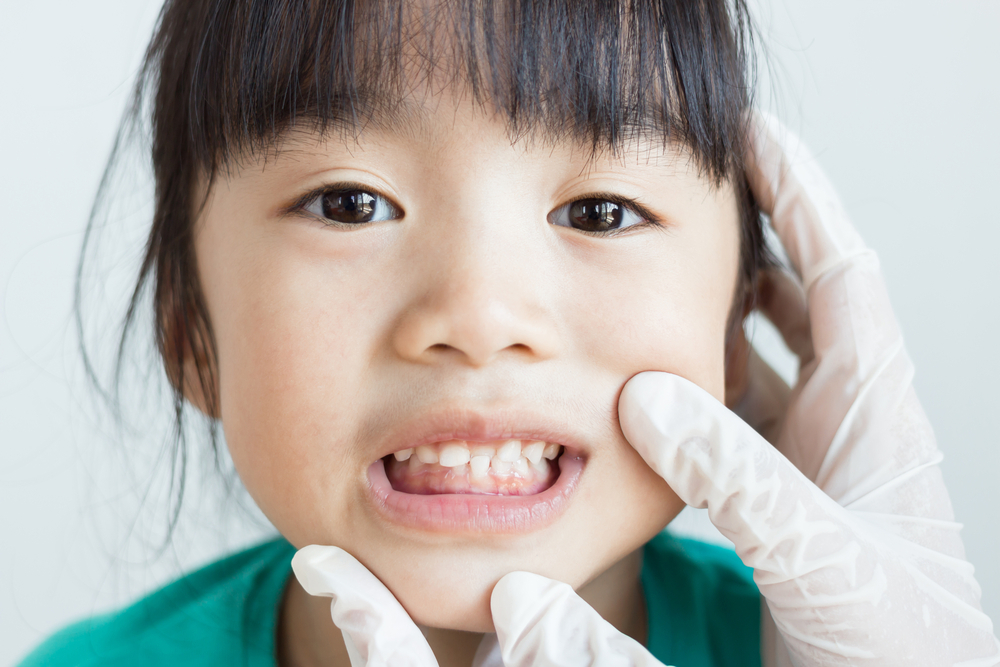 Nếu răng trẻ bị lệch lạc thì nên niềng sớm cho trẻ