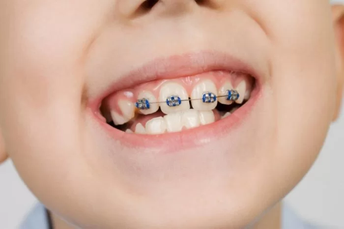 Niềng răng sớm cho trẻ sẽ hạn chế các bệnh lý về răng miệng