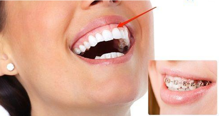 Niềng răng vừa có thể làm răng đều hơn, vừa có thể hỗ trợ làm giảm hở lợi