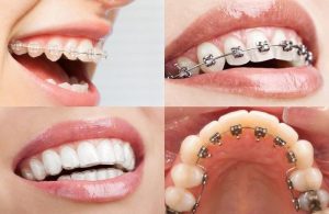 Lý giải nguyên nhân niềng răng làm răng bị rụng sớm 