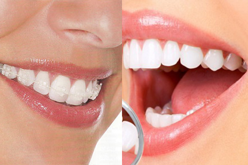 Nên bọc sứ hay niềng răng khi răng bị khấp khểnh nhẹ?