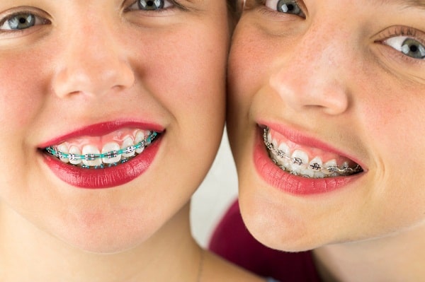 Niềng răng hỏng, cười hở lợi nặng hơn, răng bị quặp vào trong gây mất thẩm mỹ