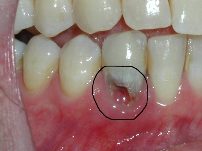 Chân răng bật ra khỏi xương hàm, chân răng bị tiêu cụt