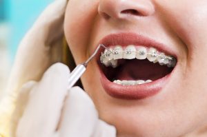 Vì sao gắn mắc cài khi niềng răng lại bị đau?