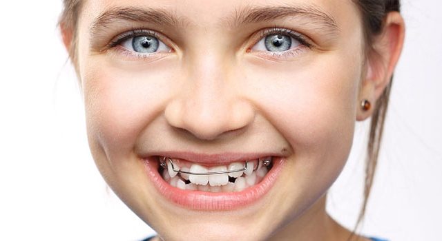 Phương pháp niềng răng bằng mắc cài cho trẻ