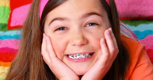 Niềng răng mắc cài nên áp dụng cho trẻ răng đã được mọc hoàn toàn