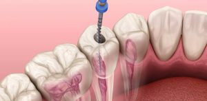 Điều trị tủy răng mất bao lâu và có nguy hiểm không