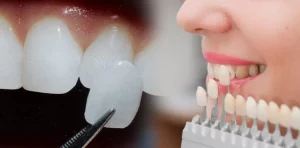 Ưu điểm của phương pháp dán răng sứ, một số lưu ý sau khi thực hiện