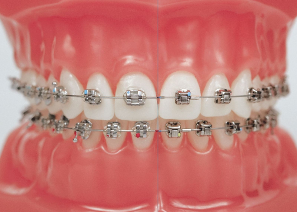 Niềng răng là một phương pháp phổ biến điều trị khớp căn sâu