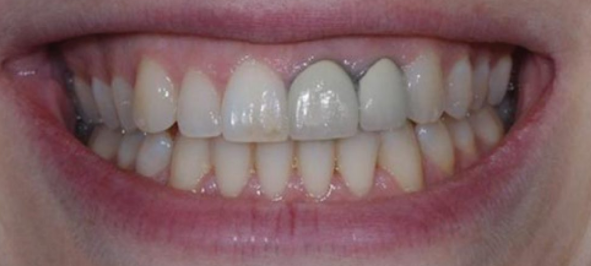 Răng bị đen sau khi bọc sứ