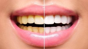 Răng bị nhiễm màu nên tẩy trắng hay bọc sứ sẽ tốt hơn?