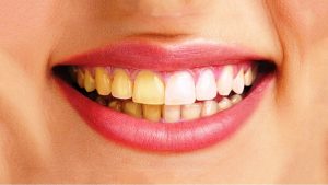 Những thói quen xấu khiến cho răng bị vàng mà bạn không ngờ tới