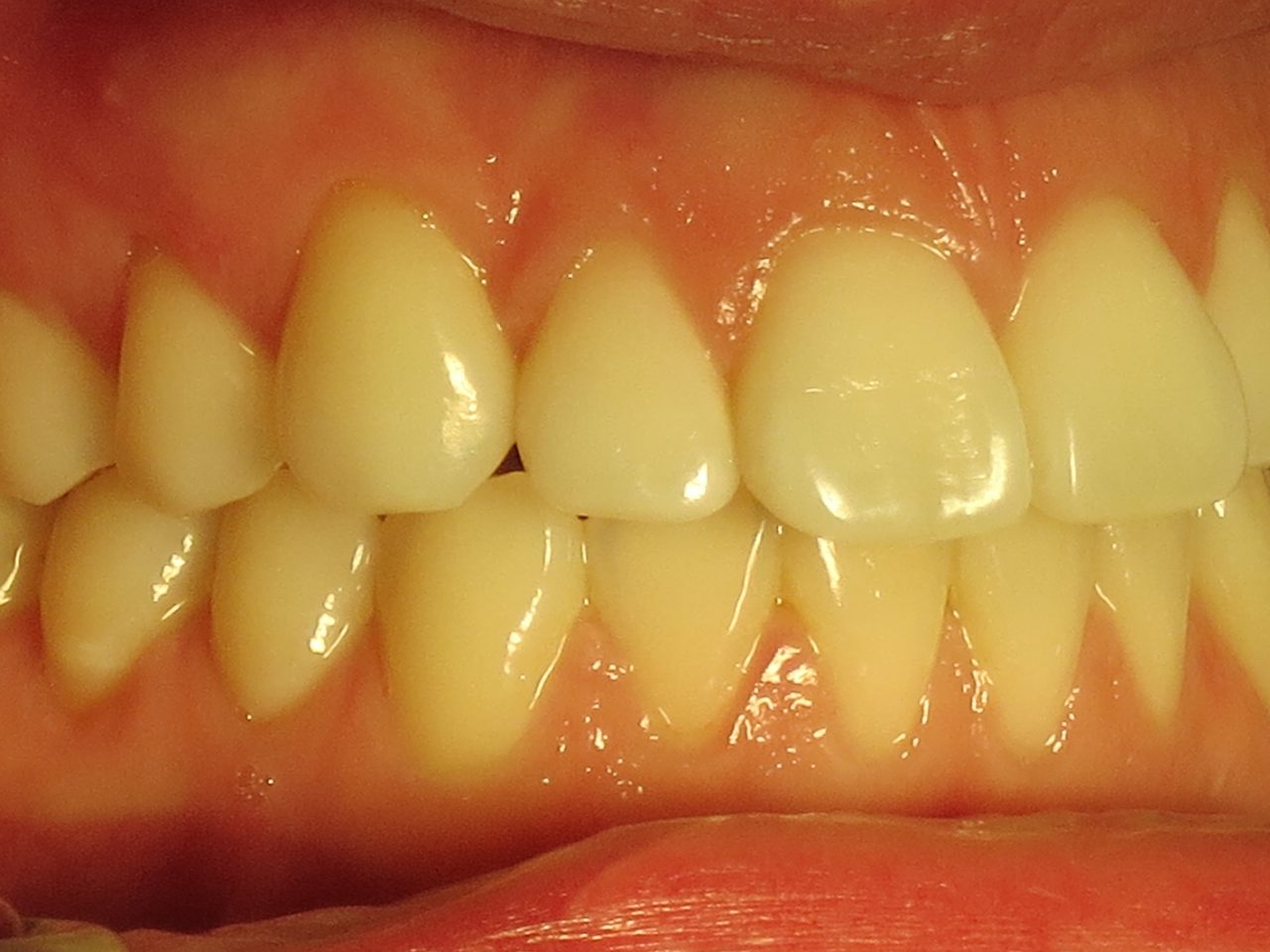 Răng bị vàng gây mất thẩm mỹ