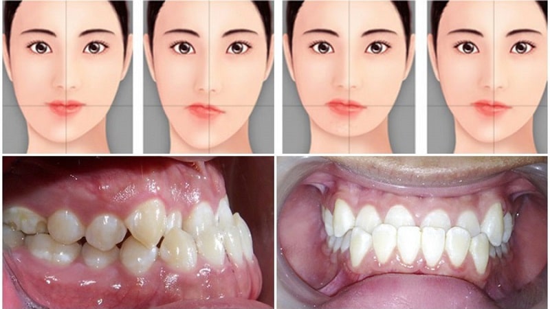 Những ảnh hưởng khi răng bị rụng
