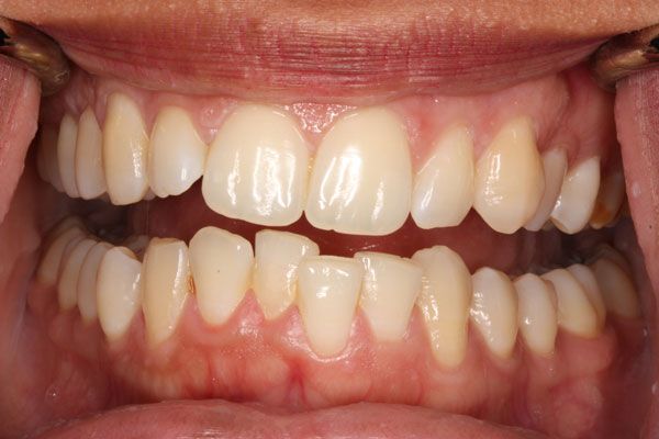 Có nhiều nguyên nhân gây khấp khểnh răng