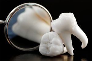 Nhổ răng khôn có nguy hiểm không và giá bao nhiêu tiền?