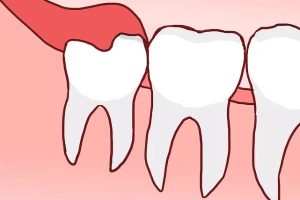Răng khôn mọc thẳng có nhất thiết phải nhổ không?