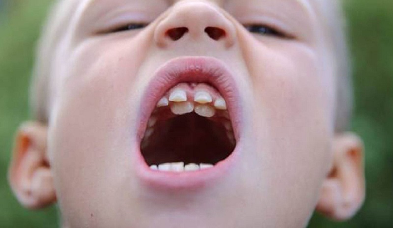 Nguyên nhân và cách xử lý răng sữa mọc lẫy ở trẻ