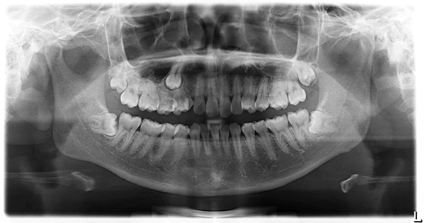 Hình ảnh x-quang răng mọc ngầm