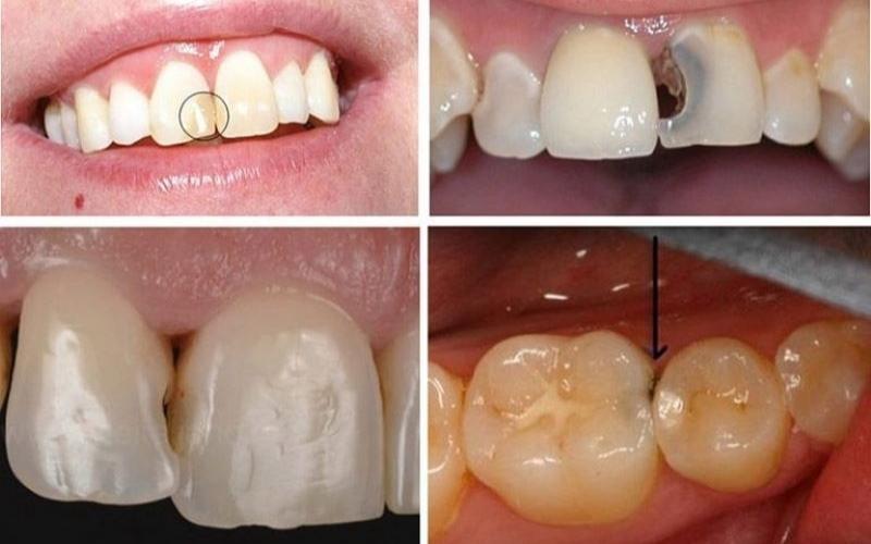 Sâu kẽ răng xuất hiện ở nhiều vị trí răng