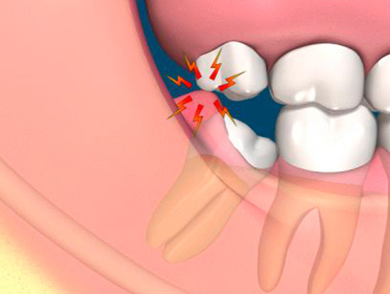 Sưng mặt gây ra bởi áp lực hoặc trầy xước mô xung quanh khu vực răng khôn