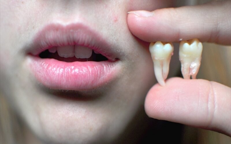 Nên chăm sóc răng, có chế độ ăn đặc biệt vết thương mau lành