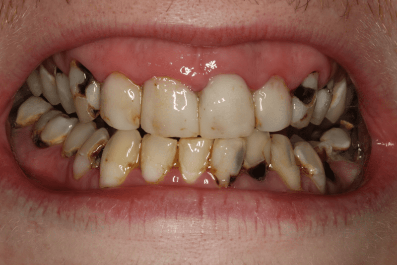 Dấu hiệu và cách điều trị sâu kẽ răng hiệu quả nhất