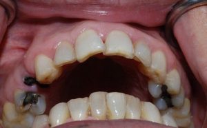 Có nên nhổ răng sâu ở hàm trên không?