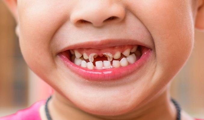 Trường hợp răng sữa bị sún ở trẻ
